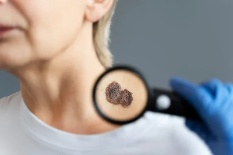 melanoma