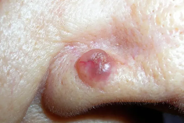 Basal Cell Carcinoma (BCC) on nose