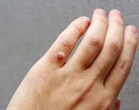 bcc hand