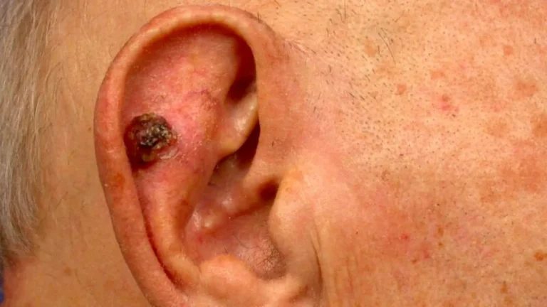 bcc on ear