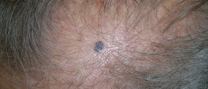bcc scalp