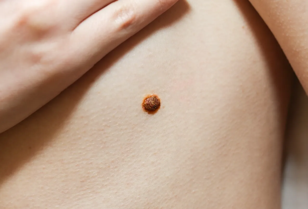 big-birthmark-on-the-girl-s-skin-medical-health-p-2026-01-11-08-10-52-utc