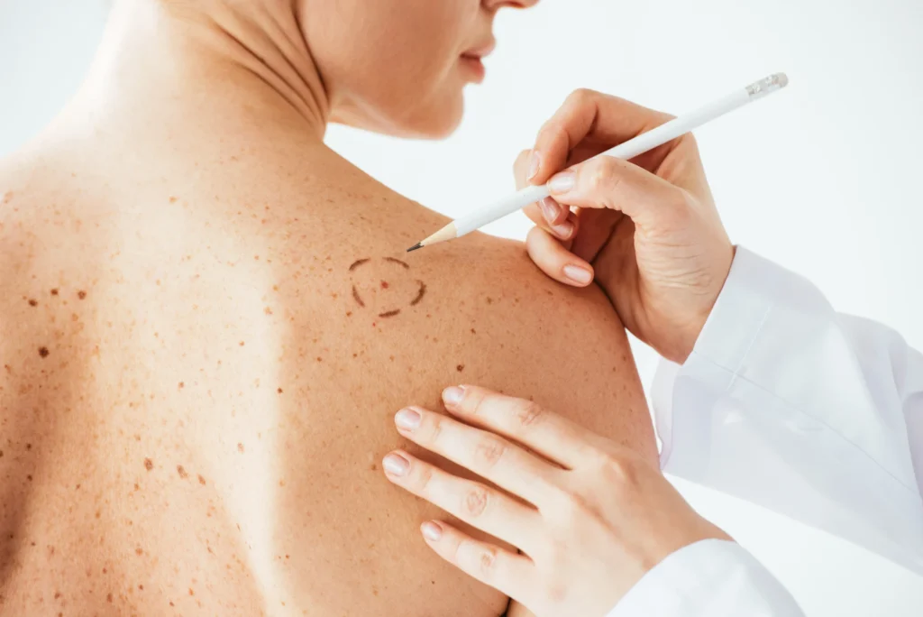Surgical marks being applied to the skin before Mohs surgery