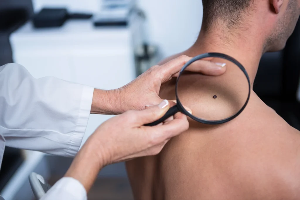 A mole being examined with a magnifying glass for signs of skin cancer