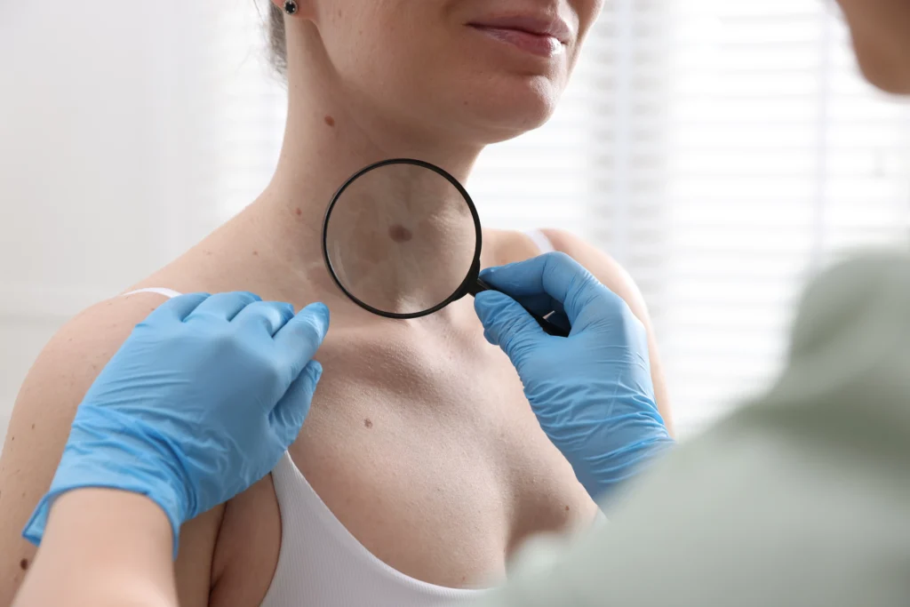 Doctor examining a woman's moles with a magnifying glass in a clinical setting, emphasizing skin cancer assessment and patient care.