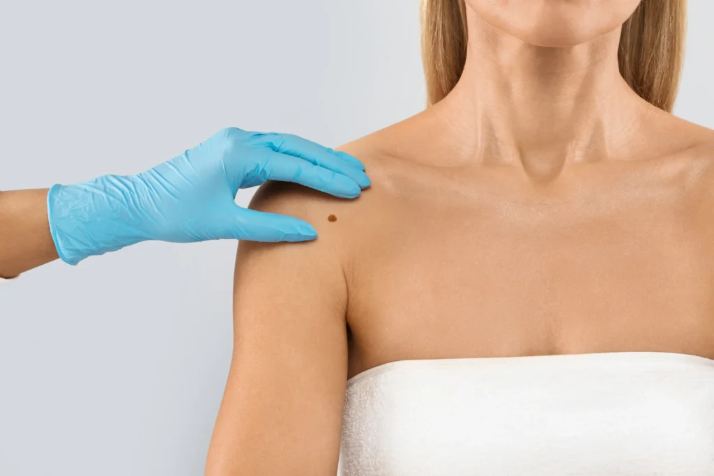 Gloved hand checking a mole on a patient’s shoulder