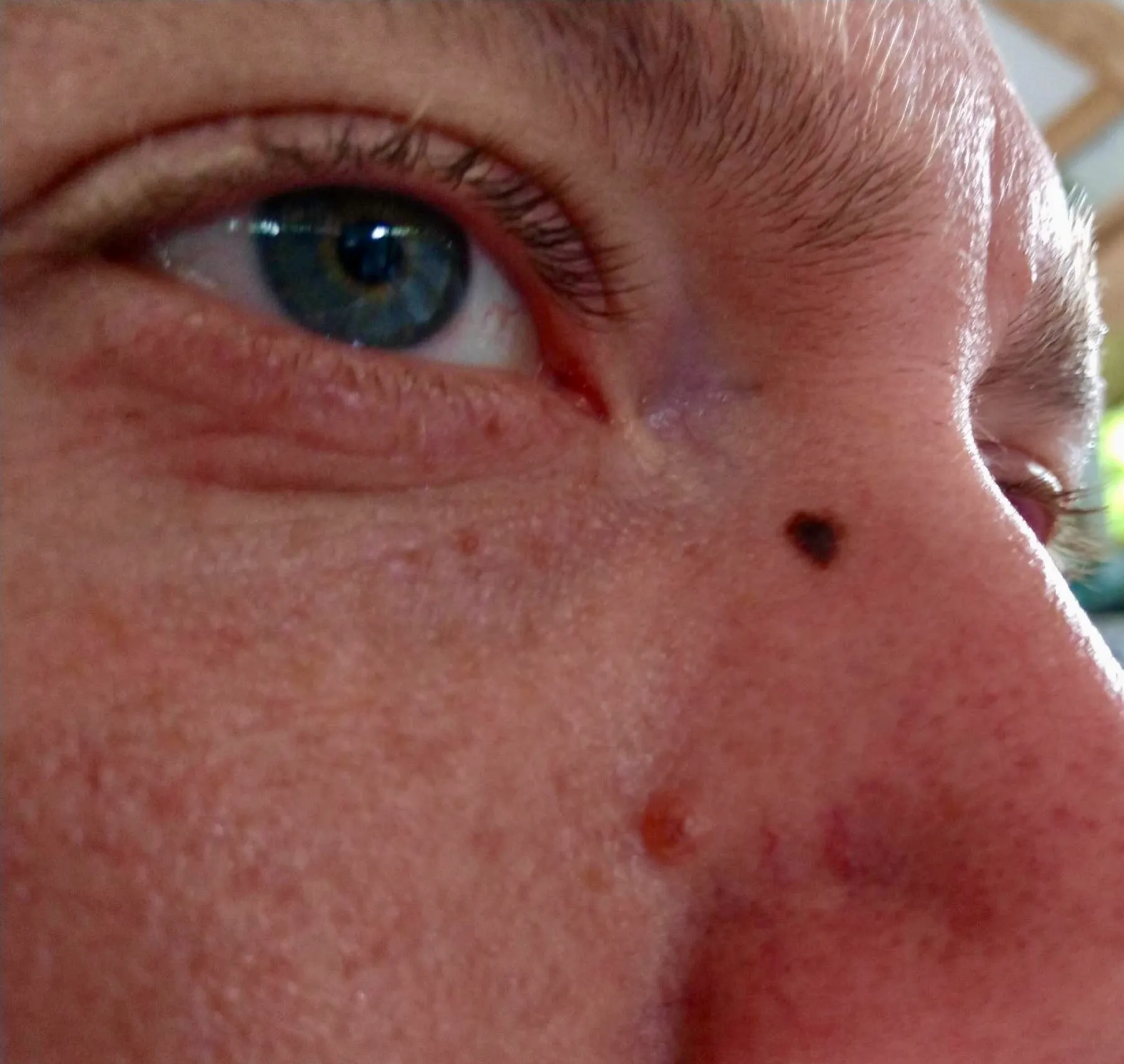 melanoma on the nose