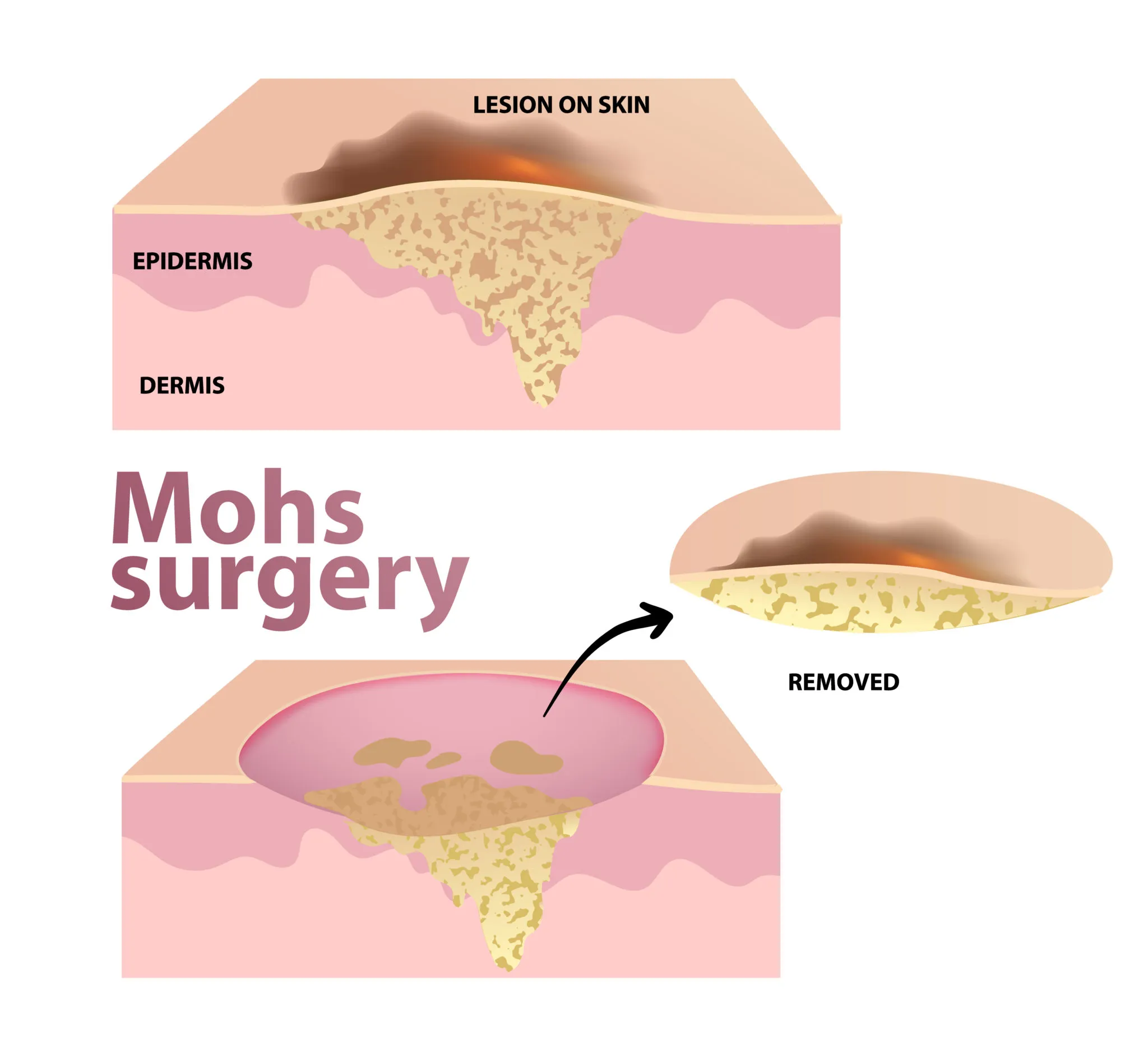 mohs