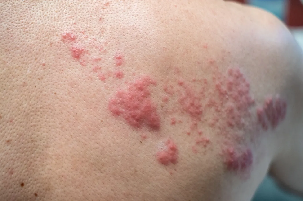 shingles-disease-herpes-zoster-varicella-zoste-2026-03-24-10-14-49-utc