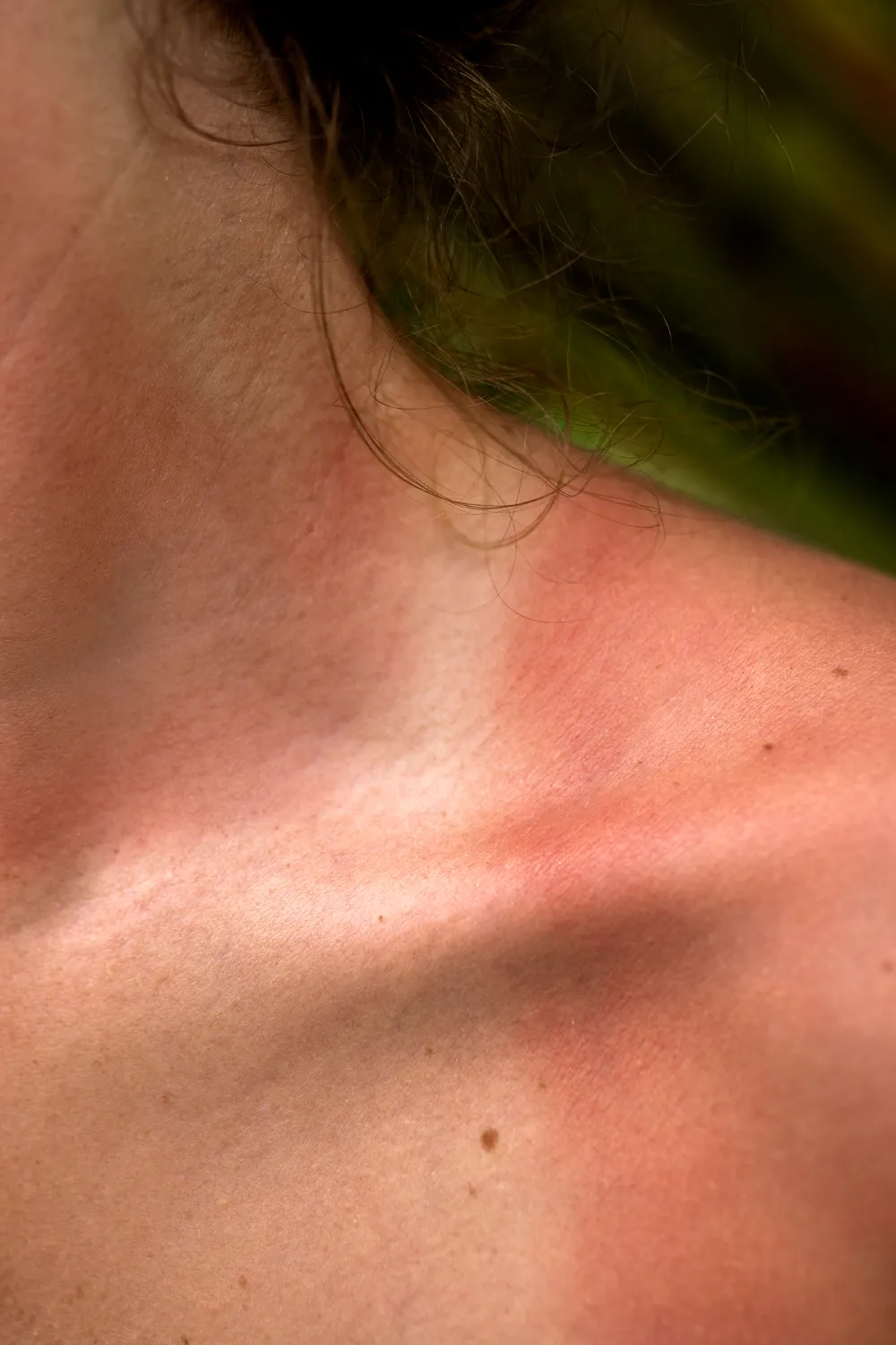 sun burn - skin