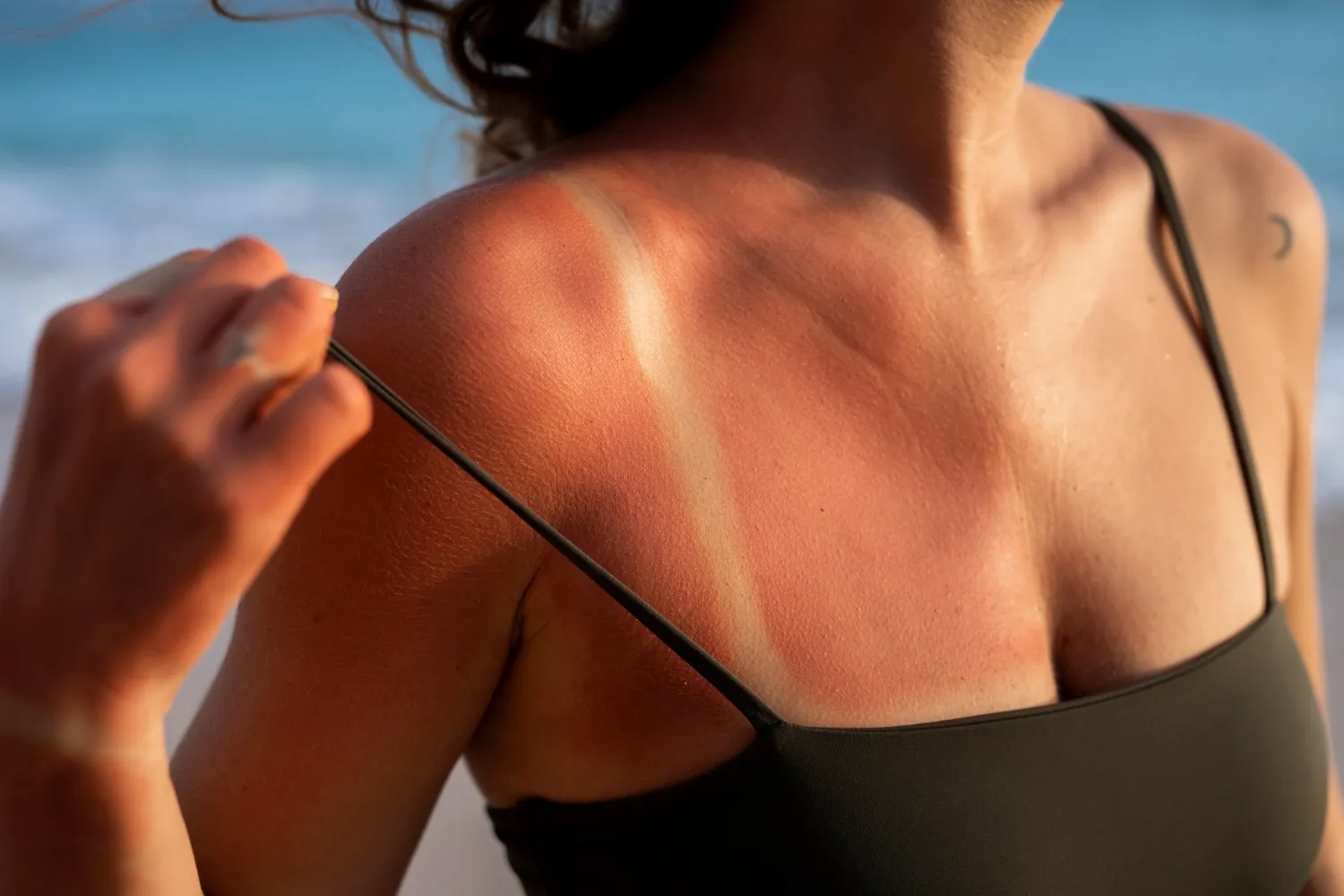 uv damage