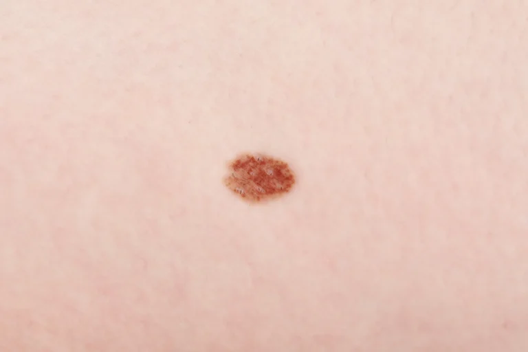 woman-with-mole-on-her-body-closeup-2026-03-26-23-26-41-utc