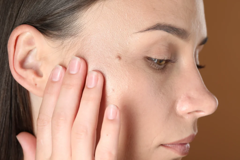 woman-with-moles-on-her-face