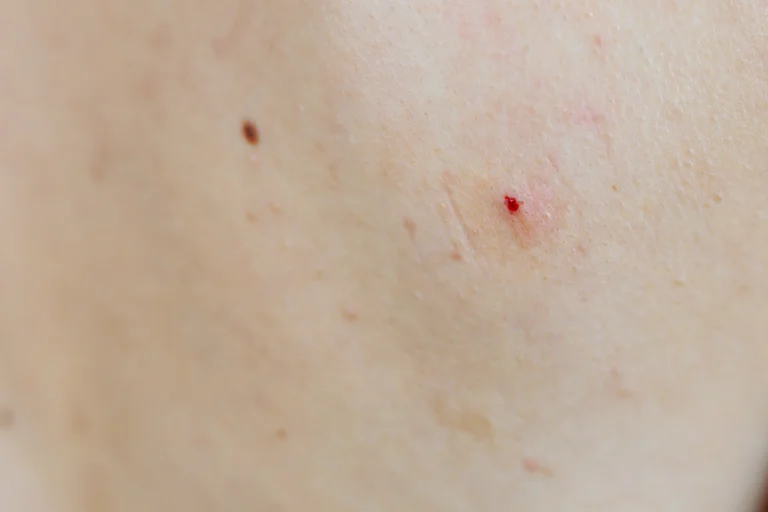 close-up-of-skin-with-bleeding-wound-2026-01-09-00-00-48-utc