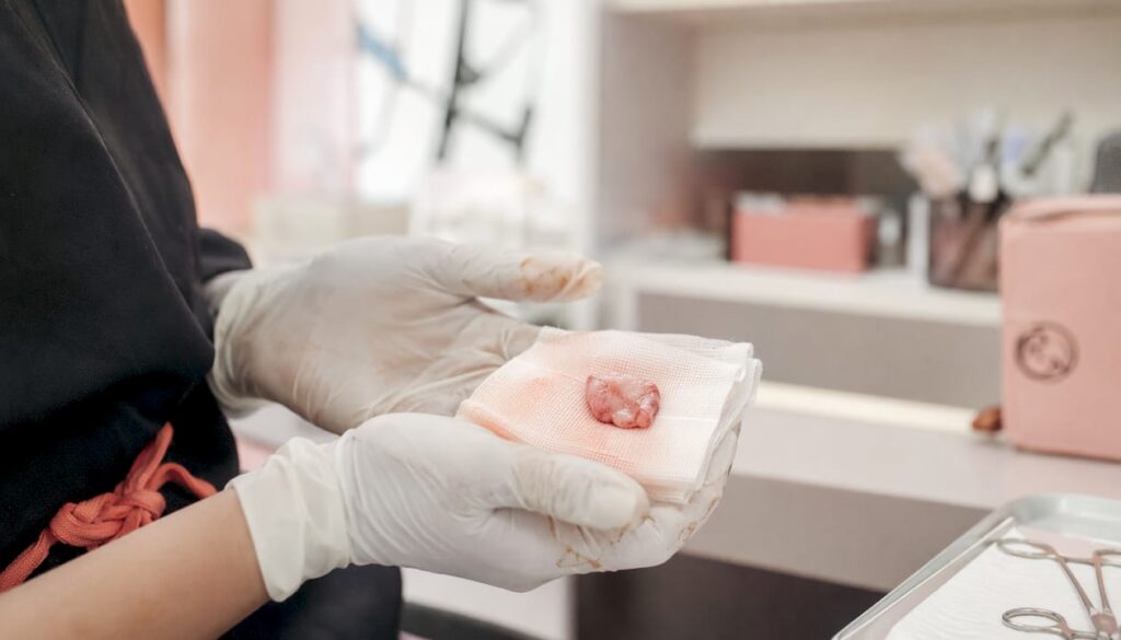 A clinician handling an excised skin tissue sample for microscopic examination