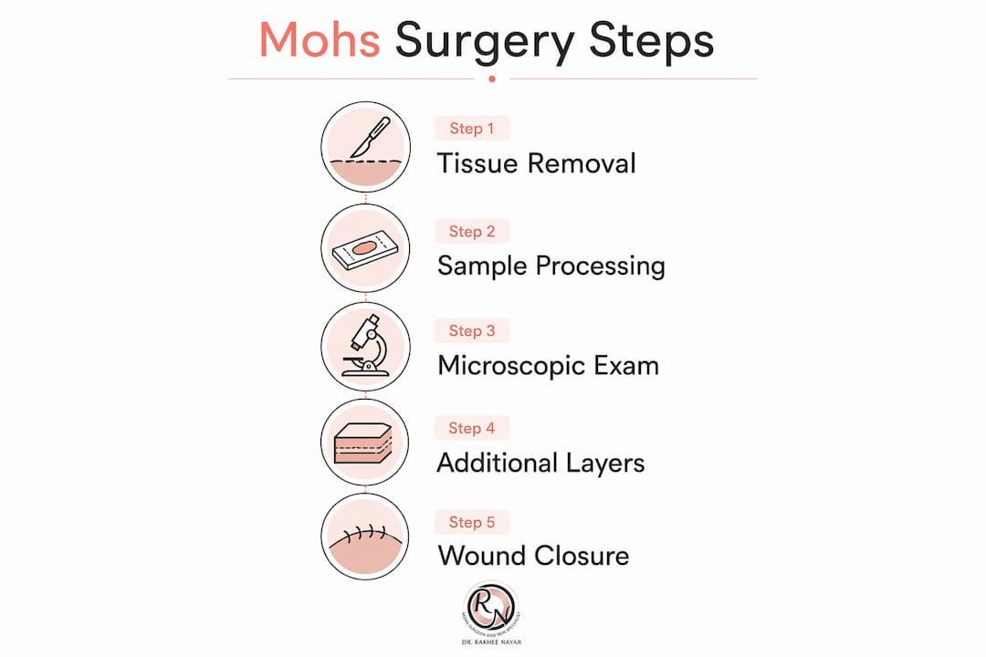 Infographic showing step-by-step Mohs surgery process
